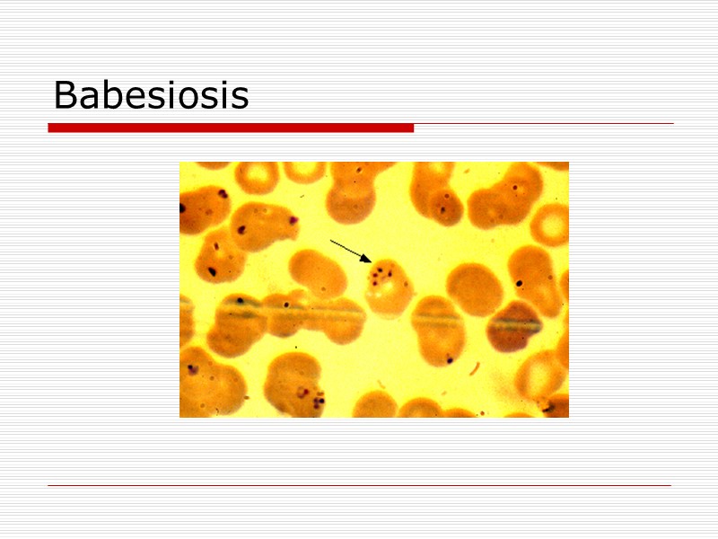 Babesiosis